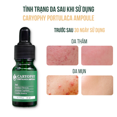 Serum Ngừa Mụn Caryophy Portulaca Ampoule 10ml