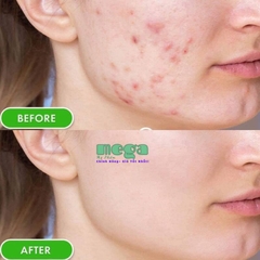 SVR Sebiaclear Active Gel 40ml Giá Bao Nhiêu? Mua Ở Đâu Chính Hãng?