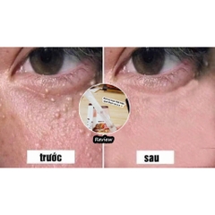 Kem Trị Mụn Thịt Mụn Gạo, Kem Xóa Nốt Ruồi Tsubuporon Nhật Bản 20g