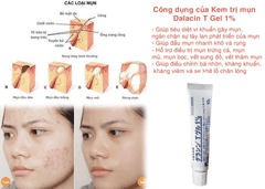 Kem trị mụn Dalacin T Gel 1% của Nhật Bản