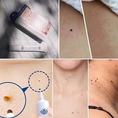 Kem Trị Mụn Thịt Mụn Gạo, Kem Xóa Nốt Ruồi Tsubuporon Nhật Bản 20g