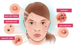 Kem trị mụn Dalacin T Gel 1% của Nhật Bản