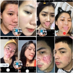 Serum Lumos Acne Chuyên Cho Da Mụn