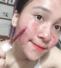 Serum So'Natural Làm Giảm Mụn, Tái Tạo Làn Da 35ml Red Peel Tingle Serum