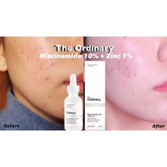 Serum dưỡng da làm mờ thâm mụn The Ordinary Niacinamide 10% + Zinc 1%