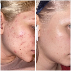 Serum the Ordinary Mandelic Acid 10% + HA tinh chất tẩy tế bào chết, làm sáng dành cho da nhạy cảm