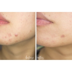 SRM Zapzyt Acne Wash Cleanser