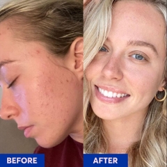 Gel giảm mụn Differin Adapalene 0.1%