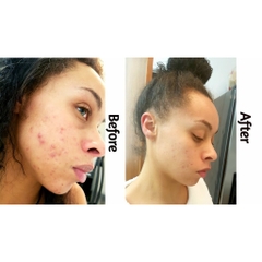 Serum The Ordinary Retinol 0,2 & 0,5% in Squalane đẩy lùi dấu hiệu lão hoá và xoá mờ khuyết điểm trên da