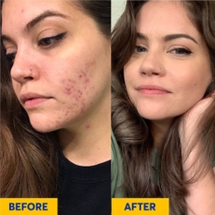 Gel giảm mụn Differin Adapalene 0.1%