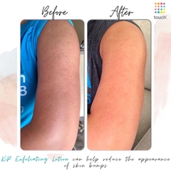 Kem dưỡng làm mịn da Gold Bond Rough & Bumpy skin 226g