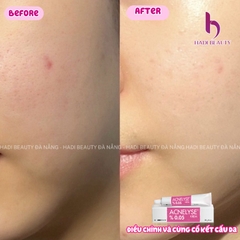 ACNELYSE. Kem Trị Mụn Tretinoin 0.05%