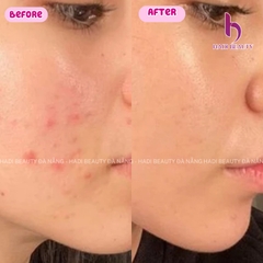 ACNELYSE. Kem Trị Mụn Tretinoin 0.05%