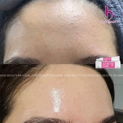 ACNELYSE. Kem Trị Mụn Tretinoin 0.05%