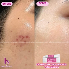 ACNELYSE. Kem Trị Mụn Tretinoin 0.05%