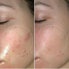 Kem dưỡng Dermacos Anti Acne