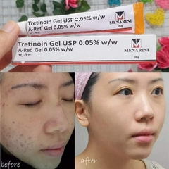 Kem Dưỡng Menarini Tretinoin 0.025%