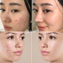 Kem trị mụn AcneDerm 20g