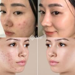 Kem trị mụn Acne Derm 20g