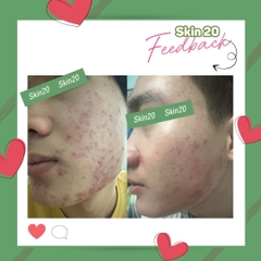 Kem tẩy tế bào chết Obagi Nuderm Exfoderm Forte (số 4) - 57g