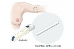 PHƯƠNG PHÁP TRÁNH THAI QUE CẤY IMPLANON