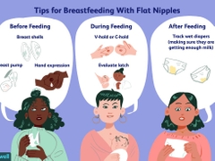 TỤT NÚM VÚ/ ĐẢO NGƯỢC NÚM VÚ