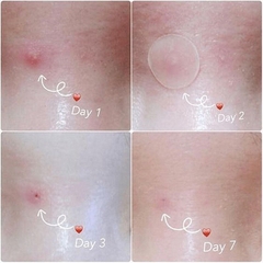 Miếng Dán Mụn Some By Mi 18 Miếng Clear Spot Patch