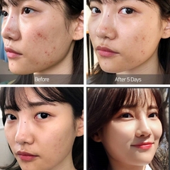 Kem giảm mụn 14 ngày SOME BY MI - AHA BHA PHA 14 Days Super Miracle Spot All Kill Cream