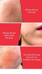 Tinh chất ốc sên đen giảm sẹo lõm - sẹo mụn Some By Mi Snail Truecica Miracle Serum
