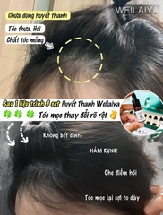 Huyết Thanh Mọc Tóc Weilaiya - Giảm Rụng Tóc, Kích Mọc Tóc Nhanh