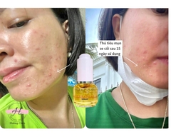 Bộ trị mụn Kem Thảo Dược & serum Macon