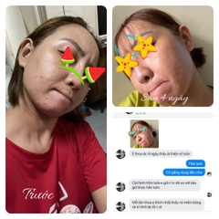 Bộ trị mụn Kem Thảo Dược & serum Macon