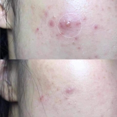 Bộ trị mụn Kem Thảo Dược & serum Macon