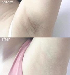 Kem Trị Thâm Nách Ngô Gia