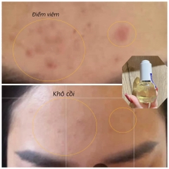 Bộ trị mụn Kem Thảo Dược & serum Macon