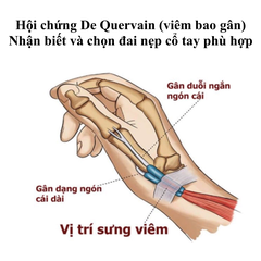 Hội chứng De Quervain (viêm bao gân): Nhận biết và chọn đai nẹp cổ tay phù hợp