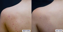 Gel Rửa Mặt & Tắm La Roche-Posay Làm Sạch & Giảm Mụn Effaclar Micro-Peeling Purifying Gel