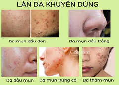 Gel Rửa Mặt SVR Không Chứa Xà Phòng Cho Da Dầu Mụn, Nhạy Cảm Sebiaclear Gel Moussant (Xanh Lá)