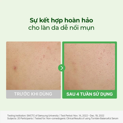 Serum TORRIDEN Làm Dịu, Giảm Mẩn Đỏ Cho Da Mụn Balanceful Cica 50ml