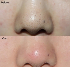Miếng Dán Hút Mụn Đầu Đen, Sợi Bã Nhờn Ciracle Blackhead Cotton Mask 5ml