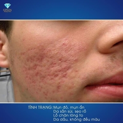 DẦU NGỰA, COENZYME Q10- TÁI TẠO DA