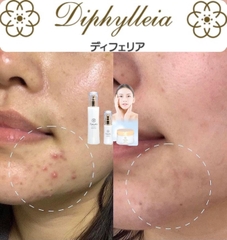 DIPHYLLEIA- CẤP ẨM, GIẢM MỤN, TÁI TẠO DA KHỎE MẠNH