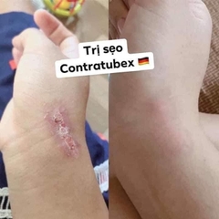 Kem trị sẹo Contractubex