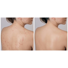 Sữa tắm A-derma giảm mụn lưng, viêm lỗ chân lông Aderma 500ml-pháp