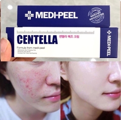 KEM TRỊ MỤN CENTELLA MEDI-PE-hàn