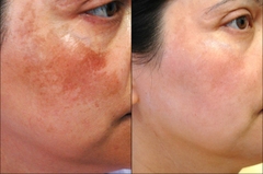 Bộ trị nám tàn nhang cao cấp - KAYOKO VÀNG Mẫu Mới 6SP-nhật