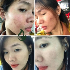 SERUM MỤN XƯƠNG RỒNG KHÔNG BONG, KHÔNG SƯNG 5ML - MỘC THIÊN HƯƠNG