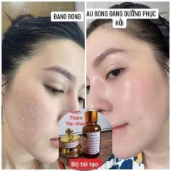COMBO KEM TRỊ NÁM , KEM DƯỠNG HỔ TRỢ TÁI TẠO DA ĐỐM NÂU, ĐỒI MỒI GIA TRUYỀN - GDN