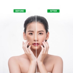 XỊT KHOÁNG GIÚP CẤP ẨM SÁNG DA TỪ THIÊN NHIÊN ACNEVIR SANTAFA - CHAI 100ML3 - SANTAFA