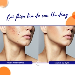 GEL GIẢM MỤN, NGĂN NGỪA HÌNH THÀNH NHÂN MỤN MỚI SALYZAP NIGHT TIME- FIXDERMA TUÝP 20G
